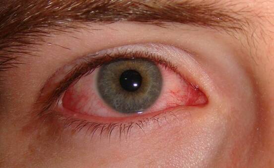 pink eye infection. and your vision is